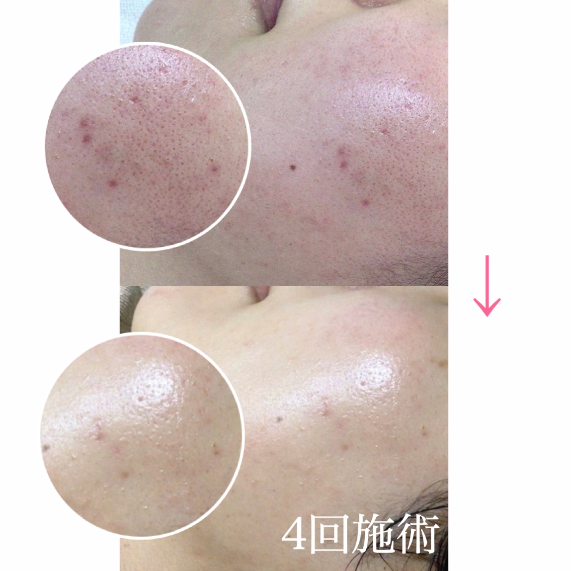毛細血管を鍛える？