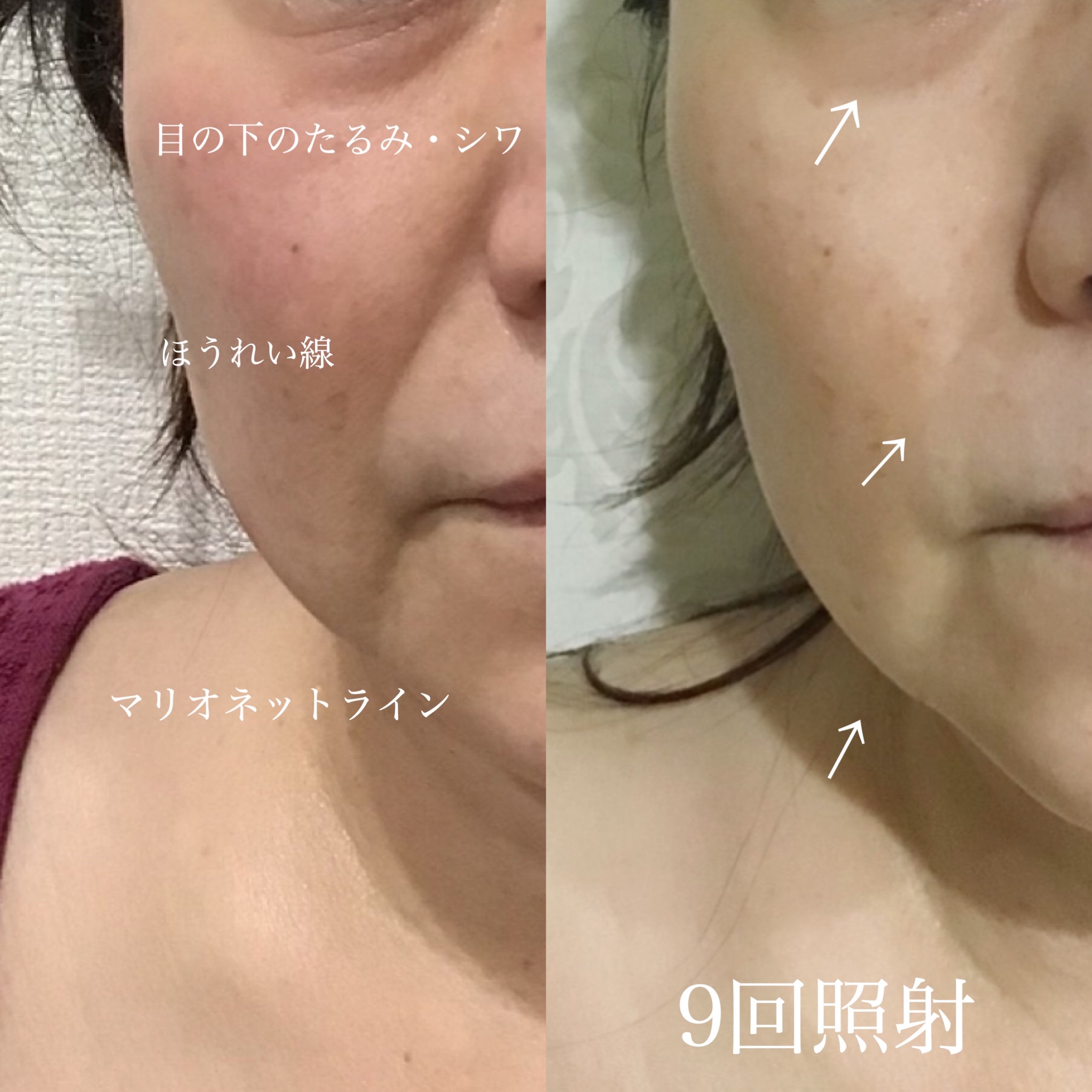 ハイスペックなハイフでお悩み改善！