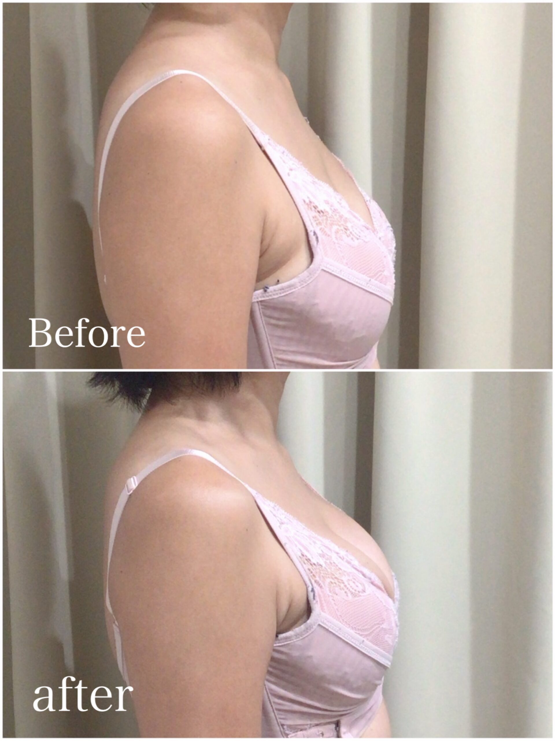 35歳授乳後バストアップ症例