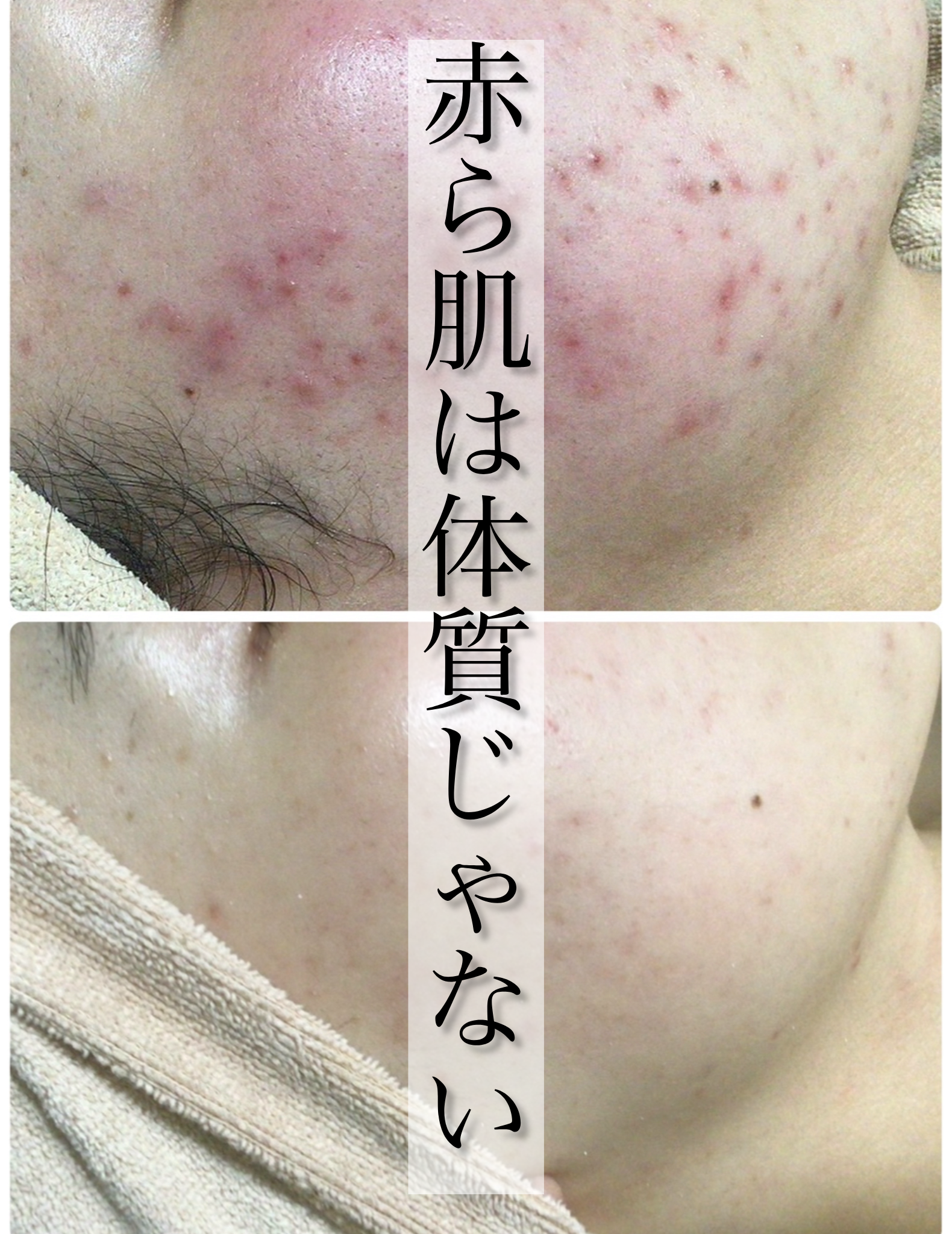 赤ら肌は「体質」ではありません